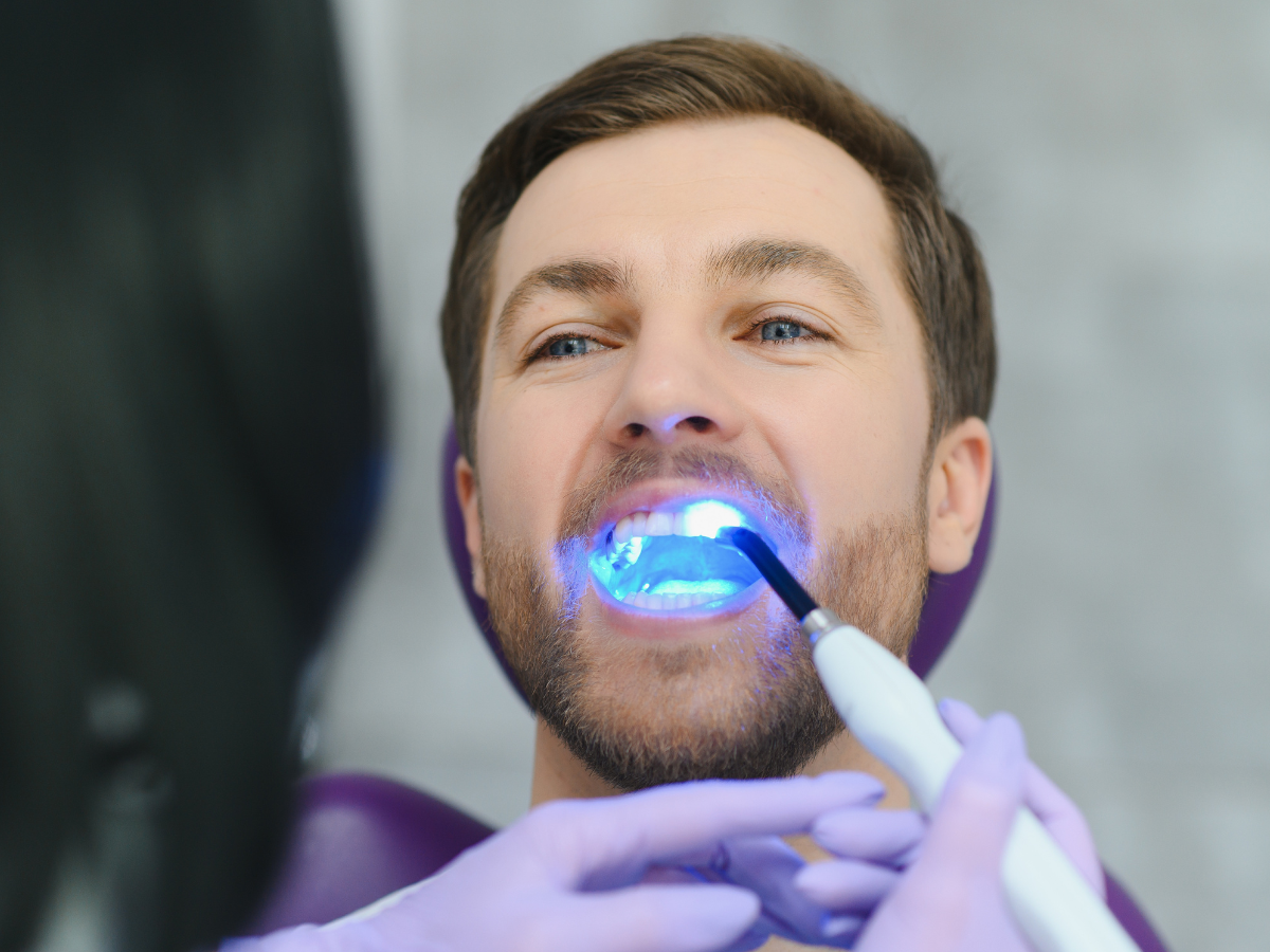 Professional Teeth Whitening vs Store Kits in San Pedro