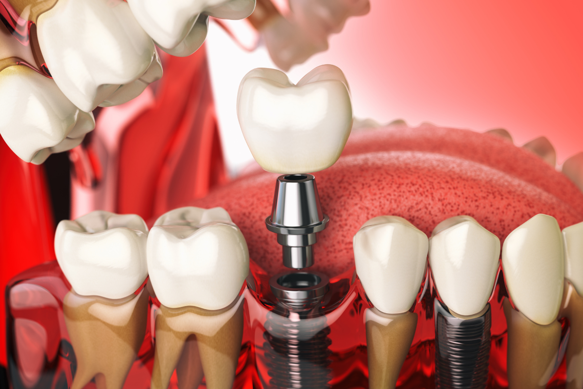 Why Are More Adults in San Pedro Choosing Dental Implants Over Bridges?